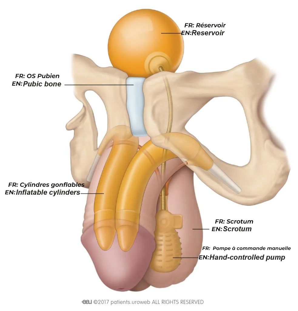 Fig. 1 : Un type courant d'implant pénien gonflable.